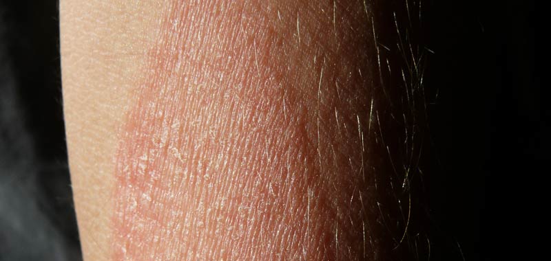 Psoriasi, attenzione alle irritazioni della cute