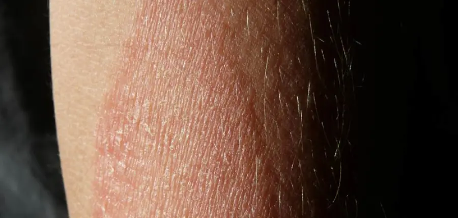 Psoriasi, attenzione alle irritazioni della cute