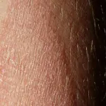 Psoriasi, attenzione alle irritazioni della cute