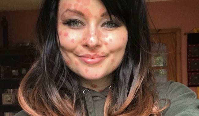 Psoriasi: Aimee Godden la ragazza che convive con la malattia