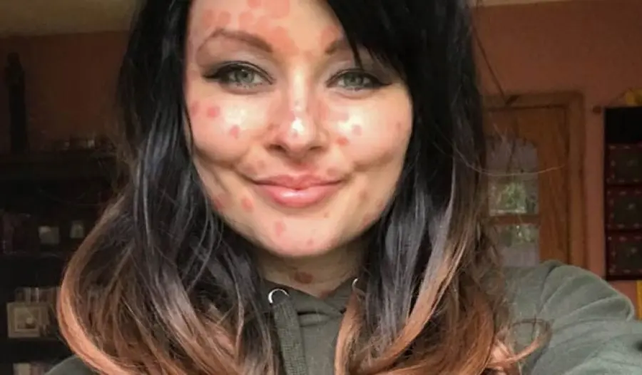 Psoriasi: Aimee Godden la ragazza che convive con la malattia