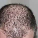 Alopecia androgenetica nuova tecnica di medicina rigenerativa