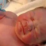 Il neonato con la spirale della madre in mano