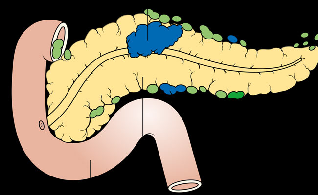 Cosa sono i linfonodi reattivi e come riconoscerli
