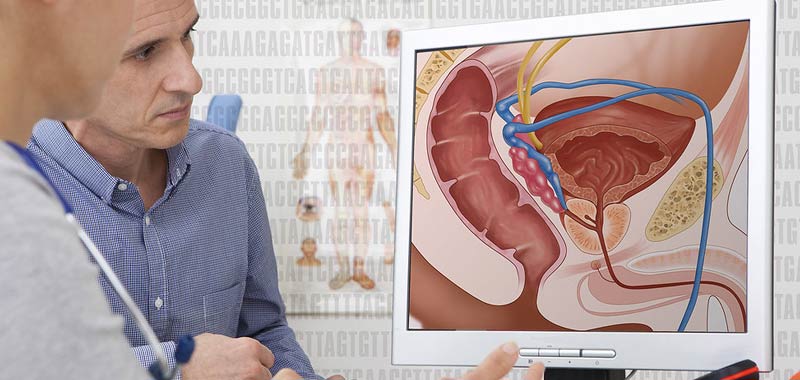 Cancro alla prostata, quali trattamenti sono consigliati?