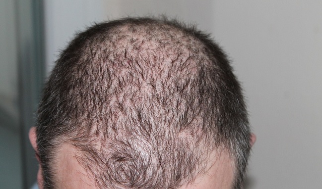 Alopecia androgenetica nuova tecnica di medicina rigenerativa
